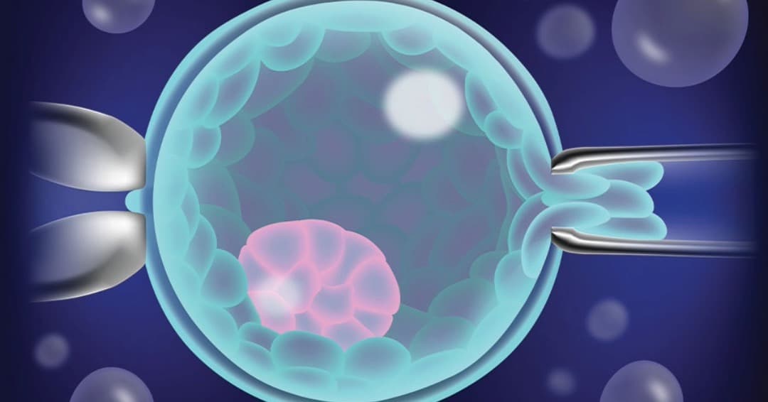 Intracytoplasmic Sperm Injection